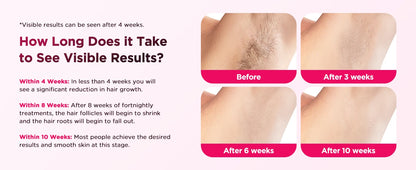 Laser Epilator IPL Hair Removal